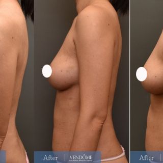 療程效果因人而異，上圖為D罩杯卻乳房下垂的女性在做完自體脂肪隆乳之後​手術後一個月、手術後八個月成效